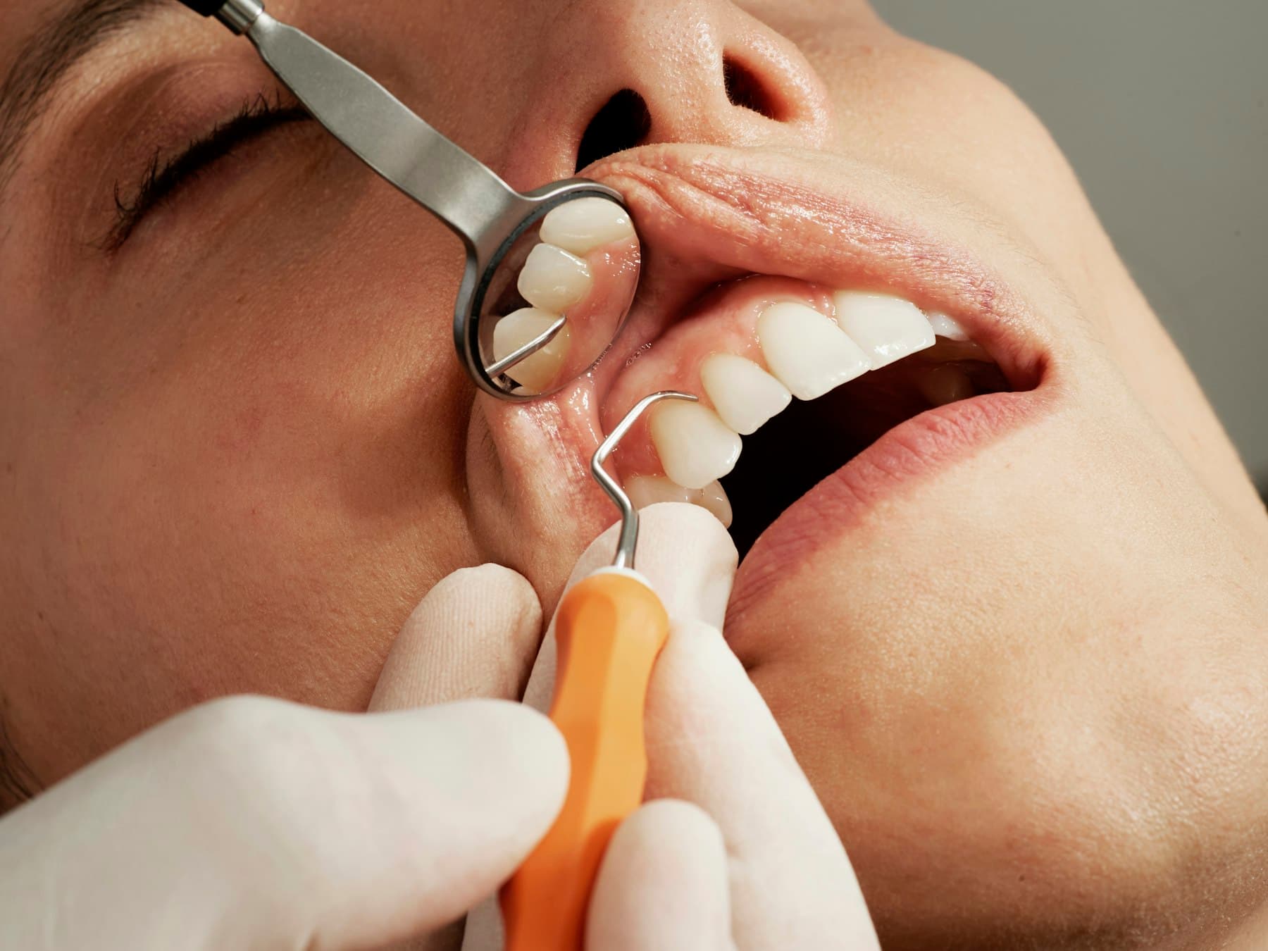 A mirror holding the lip aside while an instrument is worked along the gum margin of the upper front teeth
